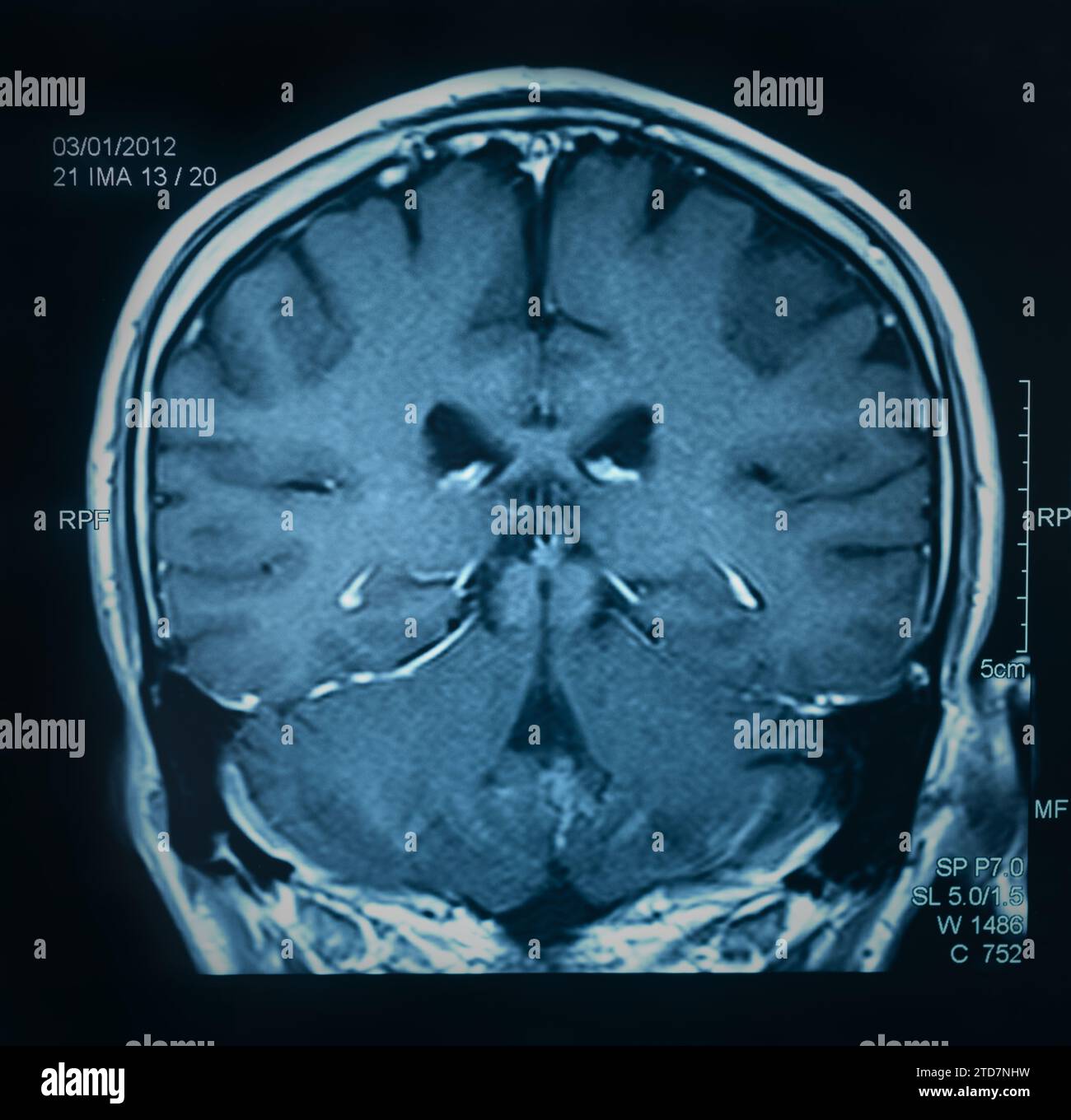 magnetic resonance image, mri scan of the brain Stock Photo - Alamy