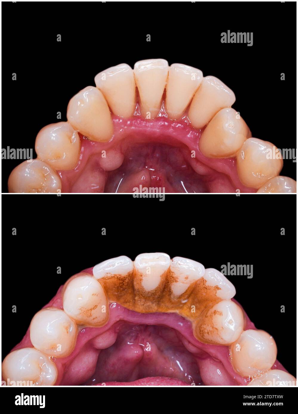Calculus (dental) teeth hi-res stock photography and images - Page