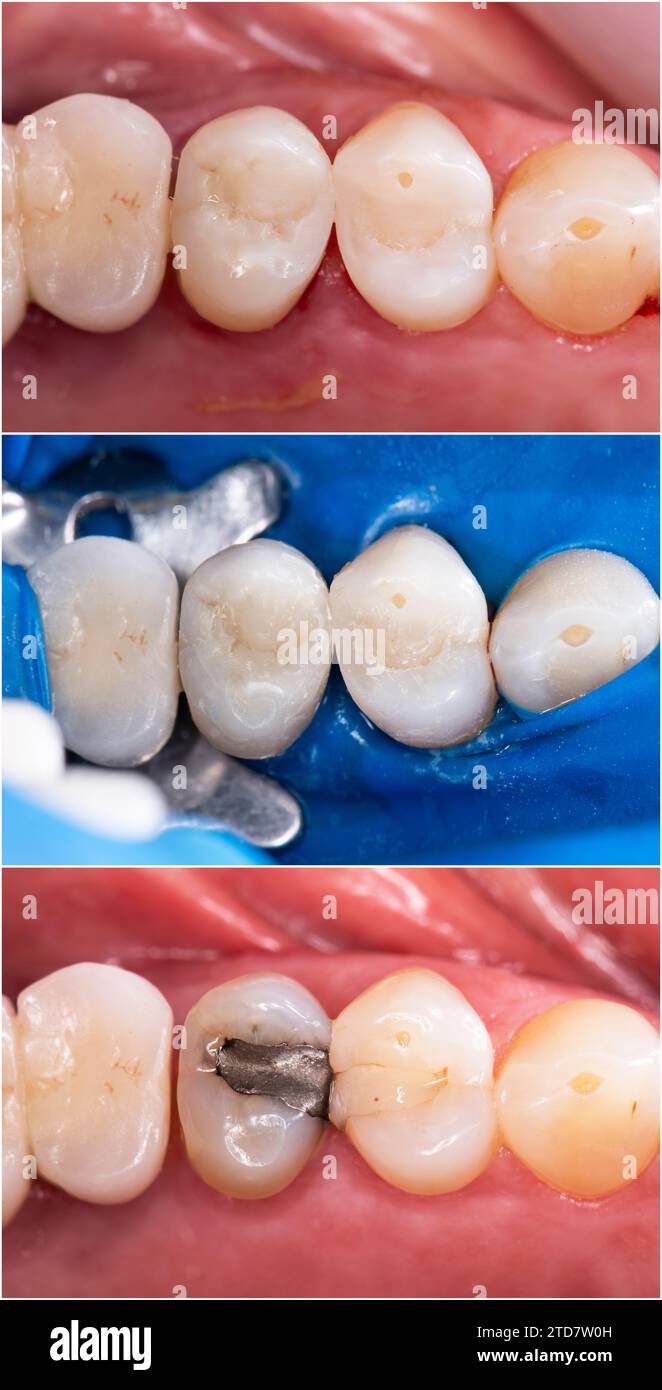 before and after picture of dental ceramic restoration on teeth and