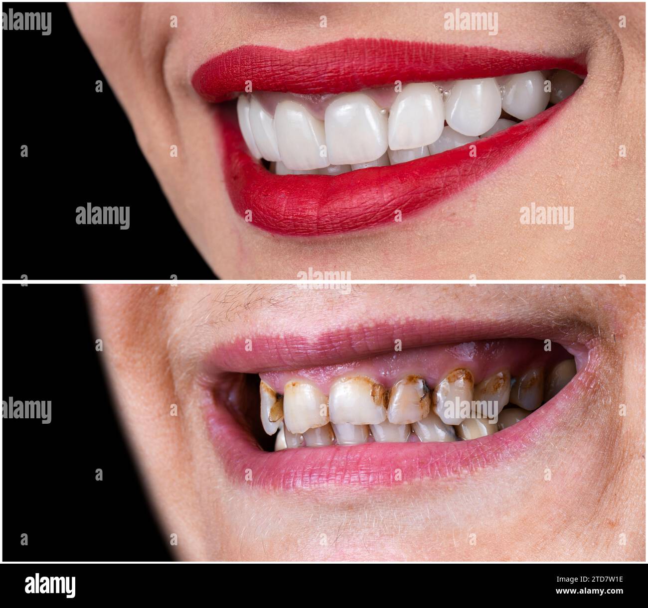 before and after picture of dental ceramic restoration on teeth and