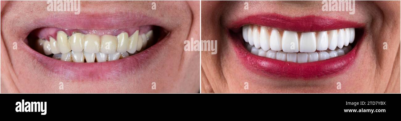 full mouth veneers bl1 color Stock Photo