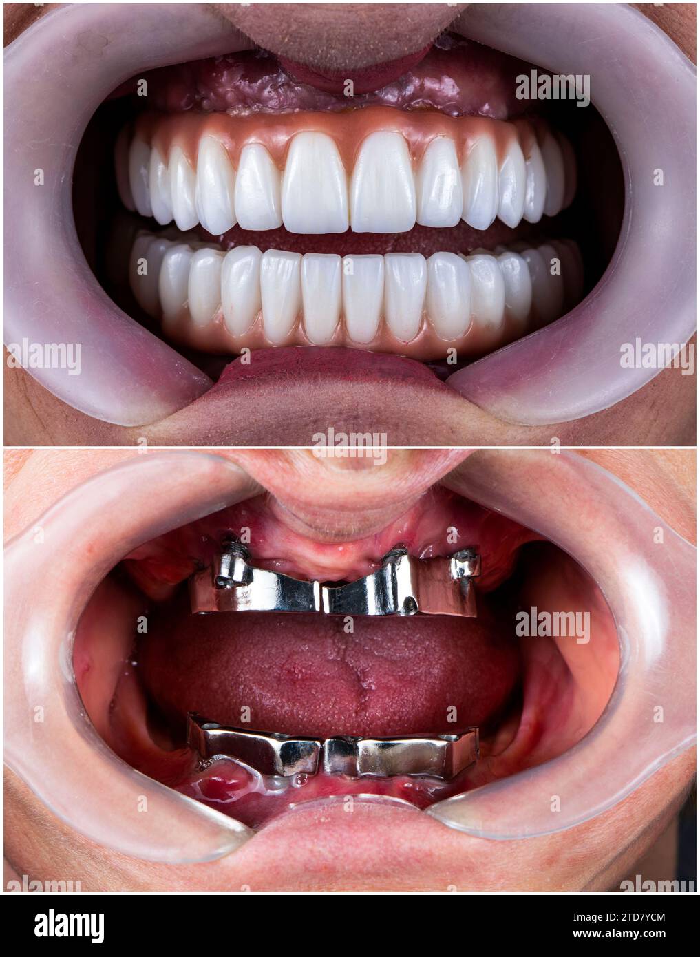 full mouth restoration by implants and zircon bridge Stock Photo Alamy