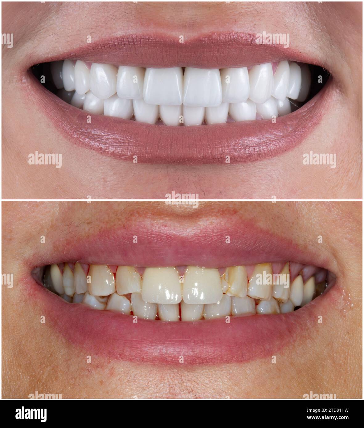 emax crowns and veneers Stock Photo Alamy