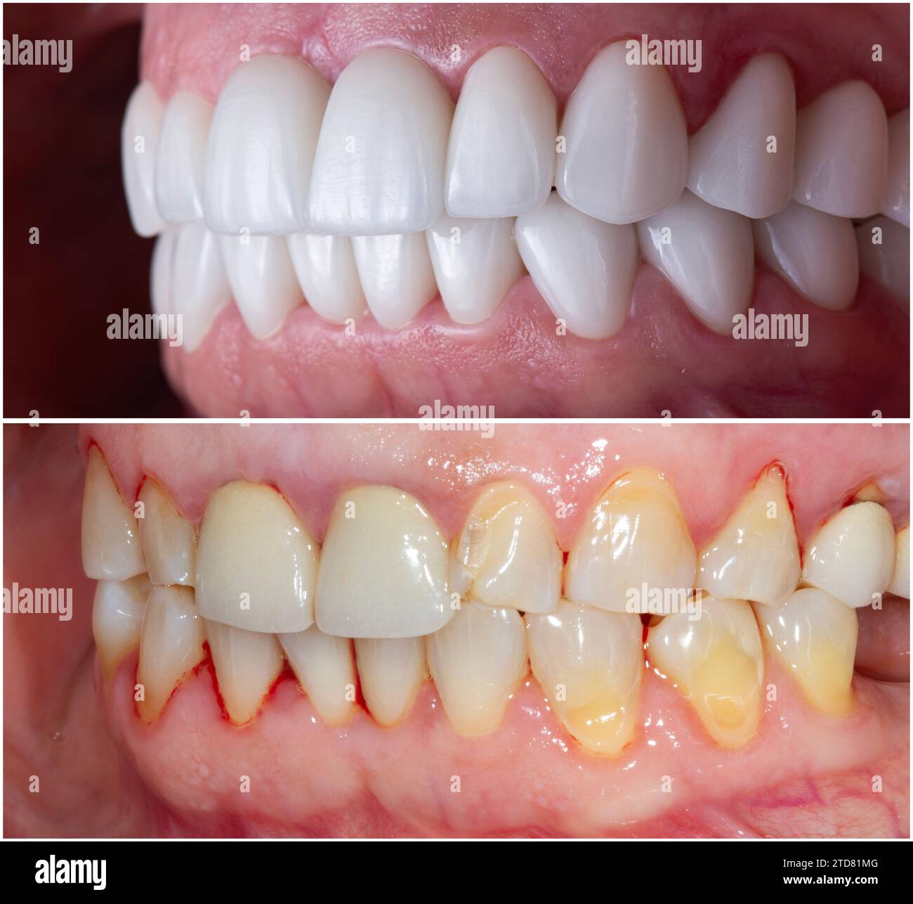 emax crowns and veneers Stock Photo Alamy