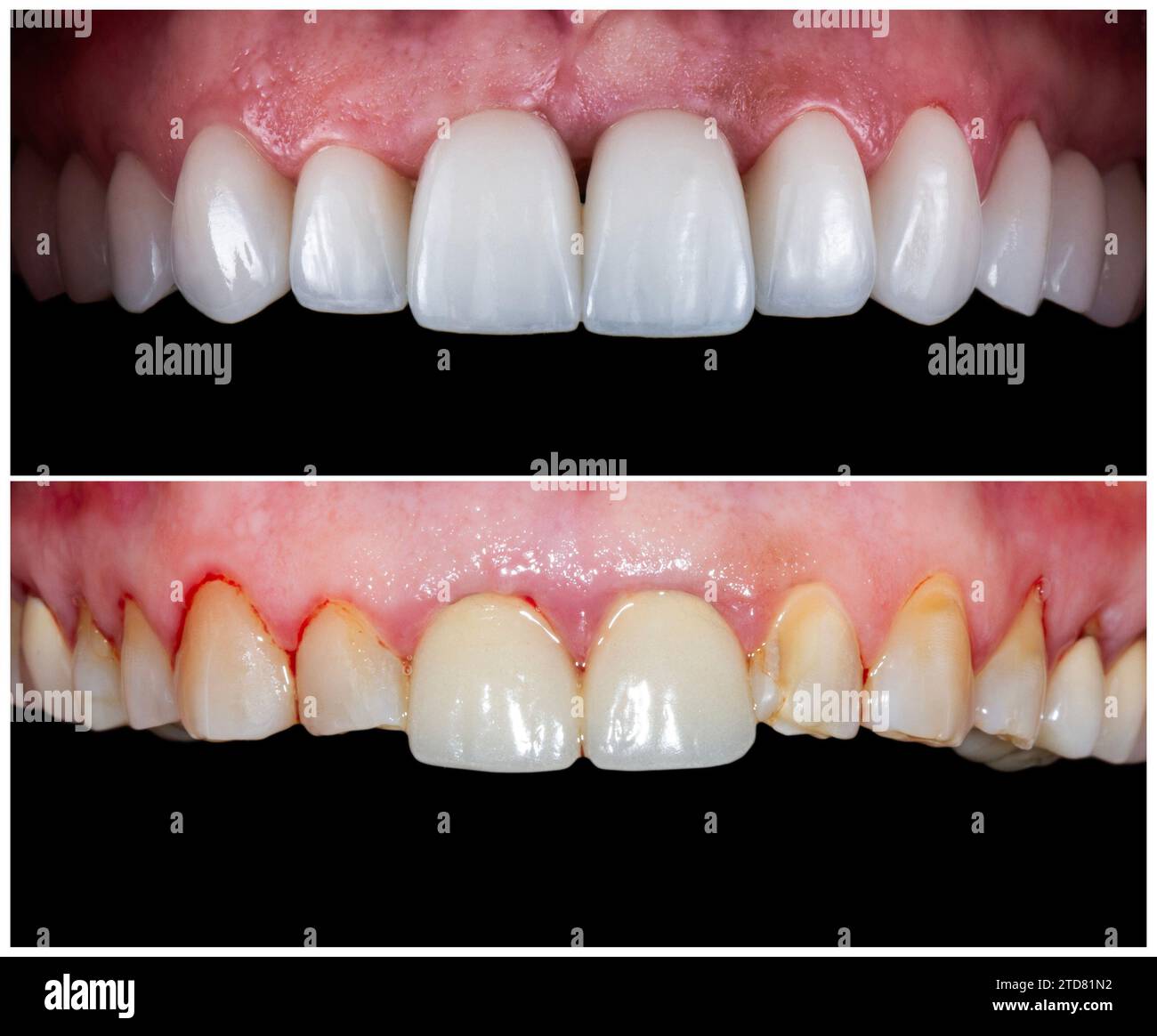emax crowns and veneers Stock Photo Alamy
