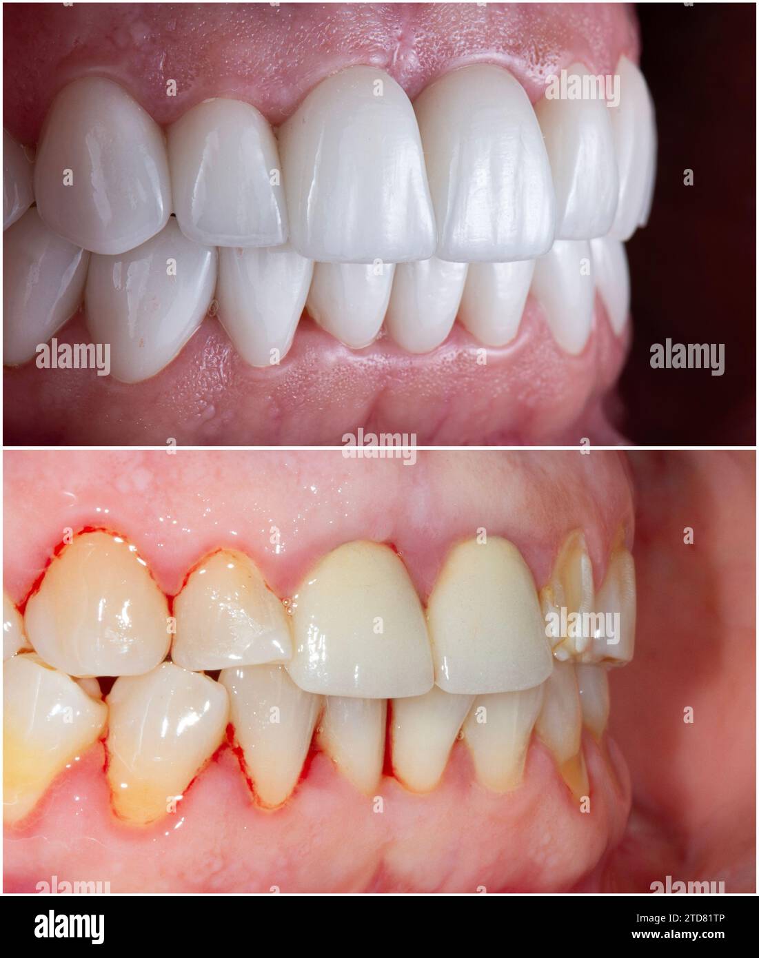 emax crowns and veneers Stock Photo Alamy