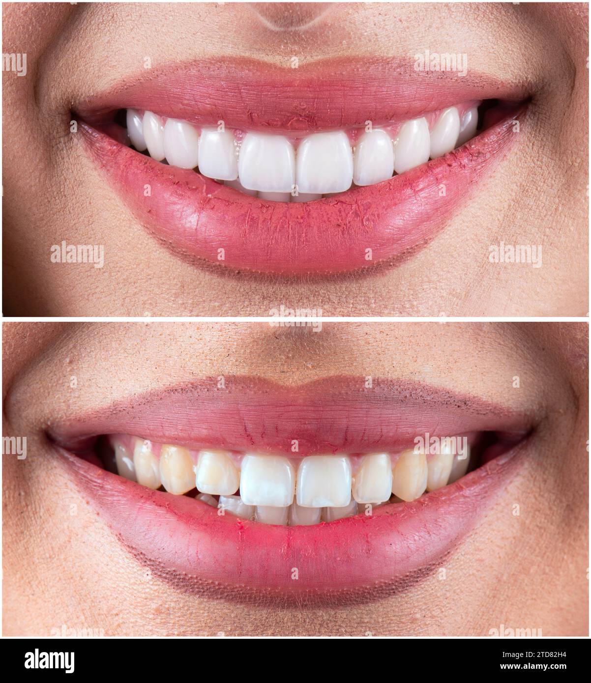 ceramic crowns and veneers Stock Photo Alamy