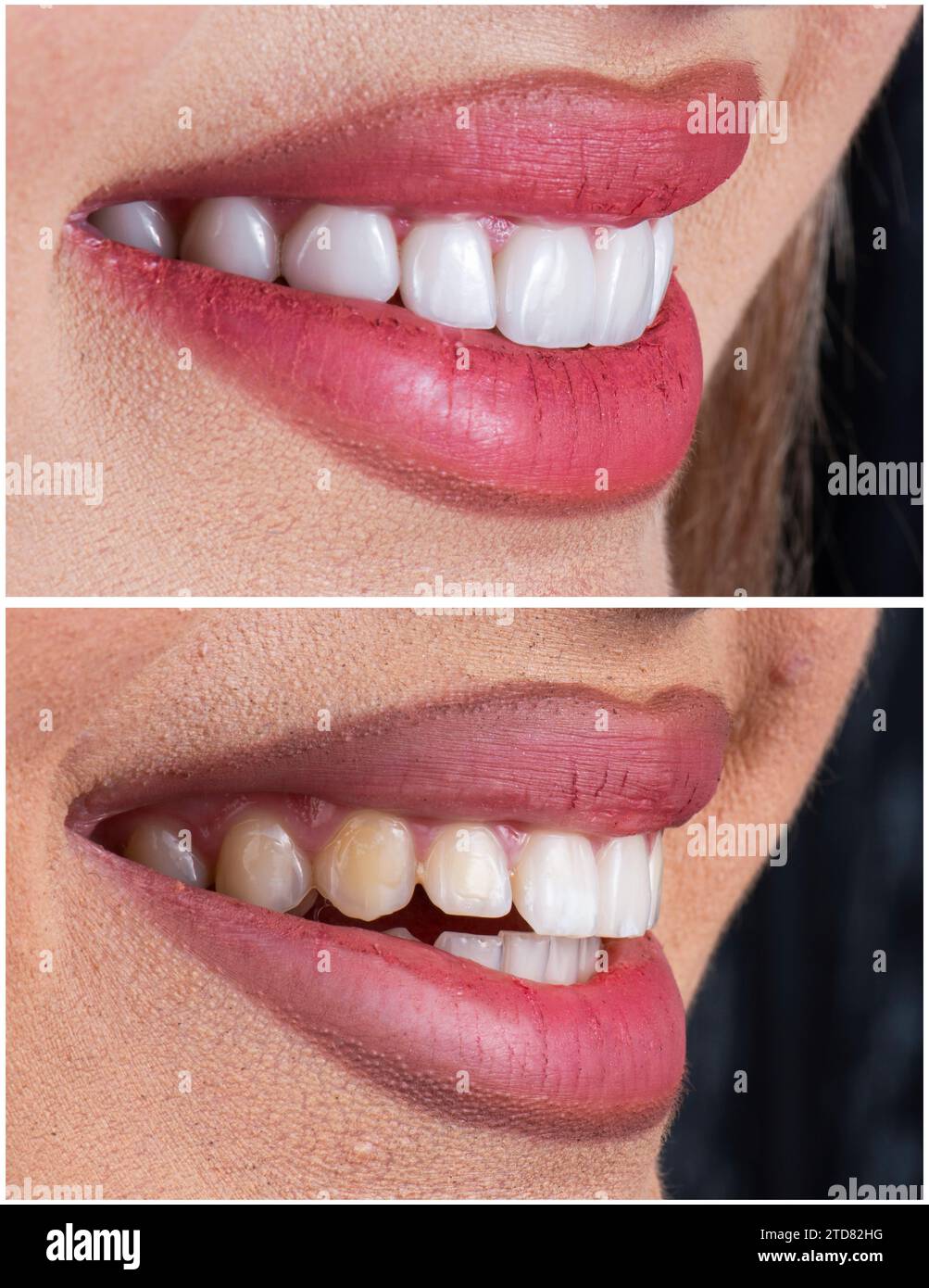 ceramic crowns and veneers Stock Photo Alamy