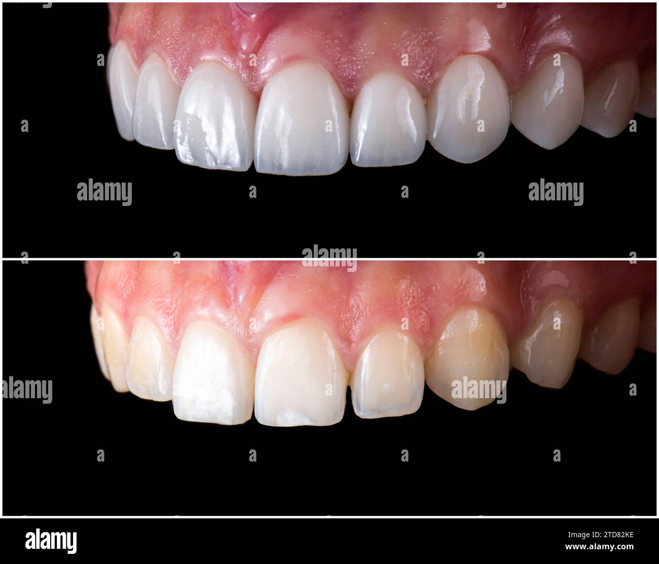 ceramic crowns and veneers Stock Photo Alamy