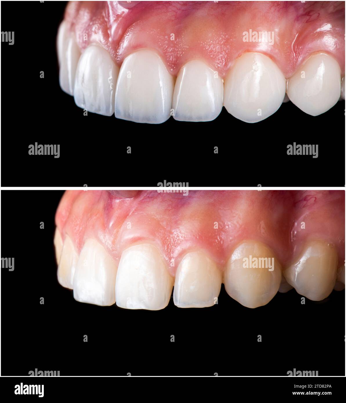 ceramic crowns and veneers Stock Photo Alamy