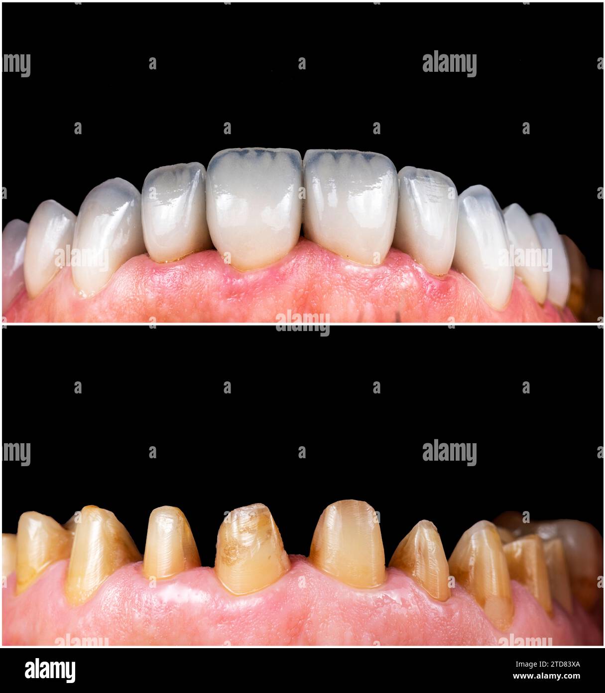 emax crowns and veneers natural color Stock Photo Alamy