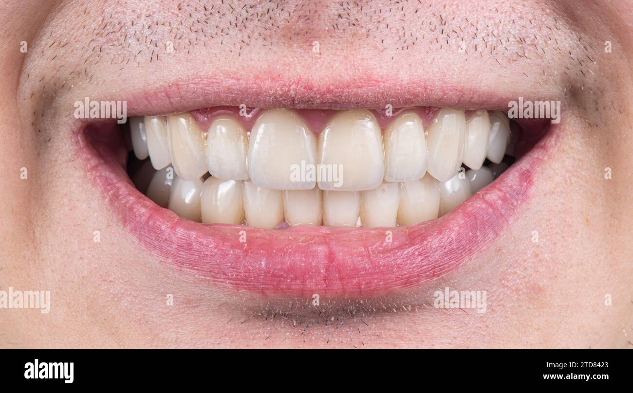 emax crowns and veneers natural color Stock Photo Alamy