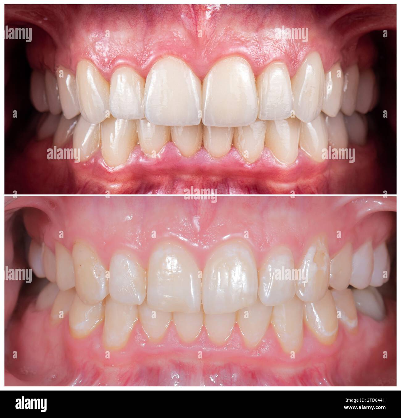 emax crowns and veneers natural color Stock Photo Alamy