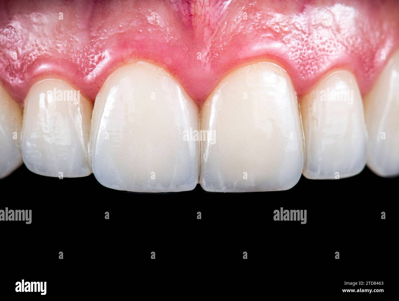 emax crowns and veneers natural color Stock Photo Alamy