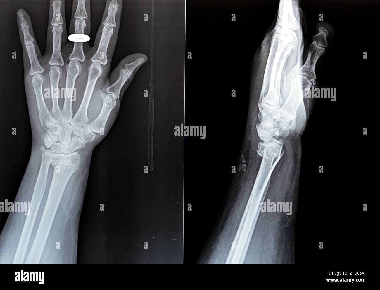 Colles' fracture of an old female, a type of fracture of the distal forearm in which the broken end of the radius is bent backwards, as a result of a Stock Photo