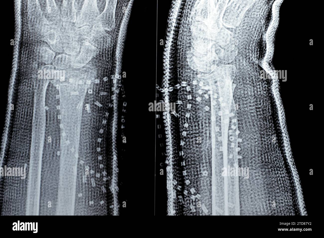 102+ Thousand Colles Fracture Royalty-Free Images, Stock Photos & Pictures