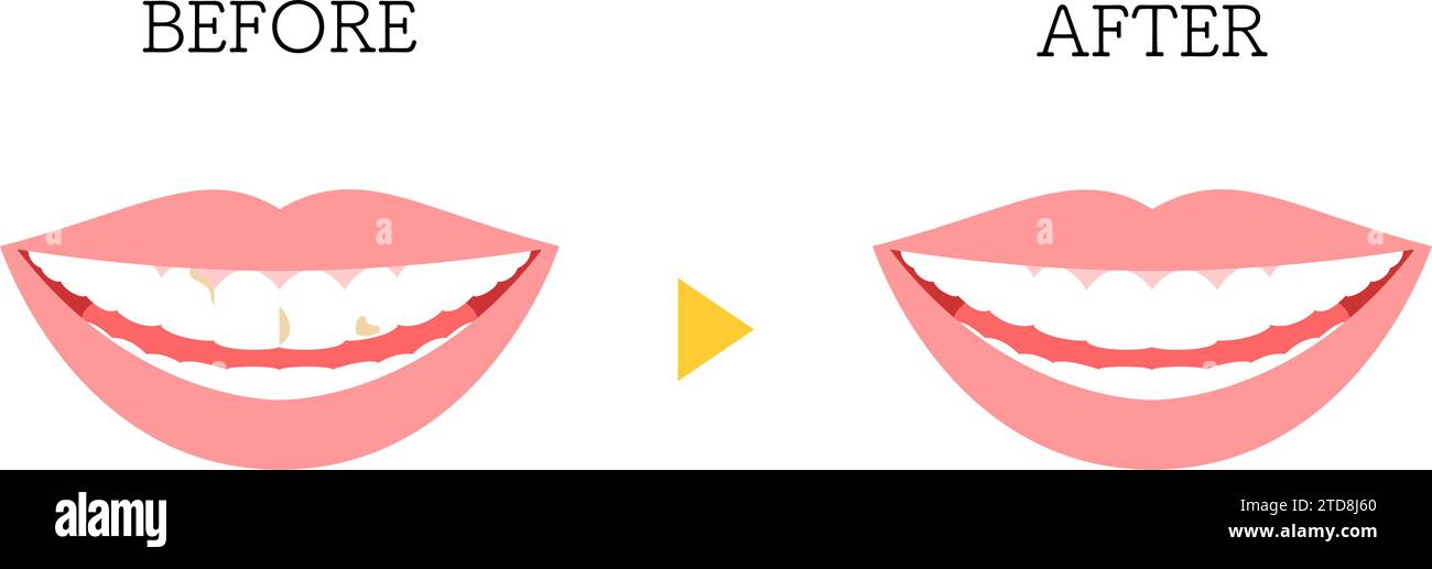 Cosmetic dentistry, direct bonding before and after, tooth discoloration, Vector Illustration