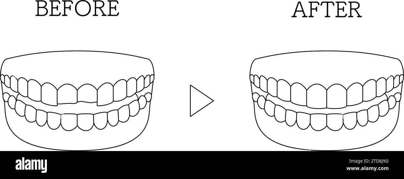 Cosmetic dentistry, direct bonding before and after, chipped tooth, Vector Illustration Stock Vector