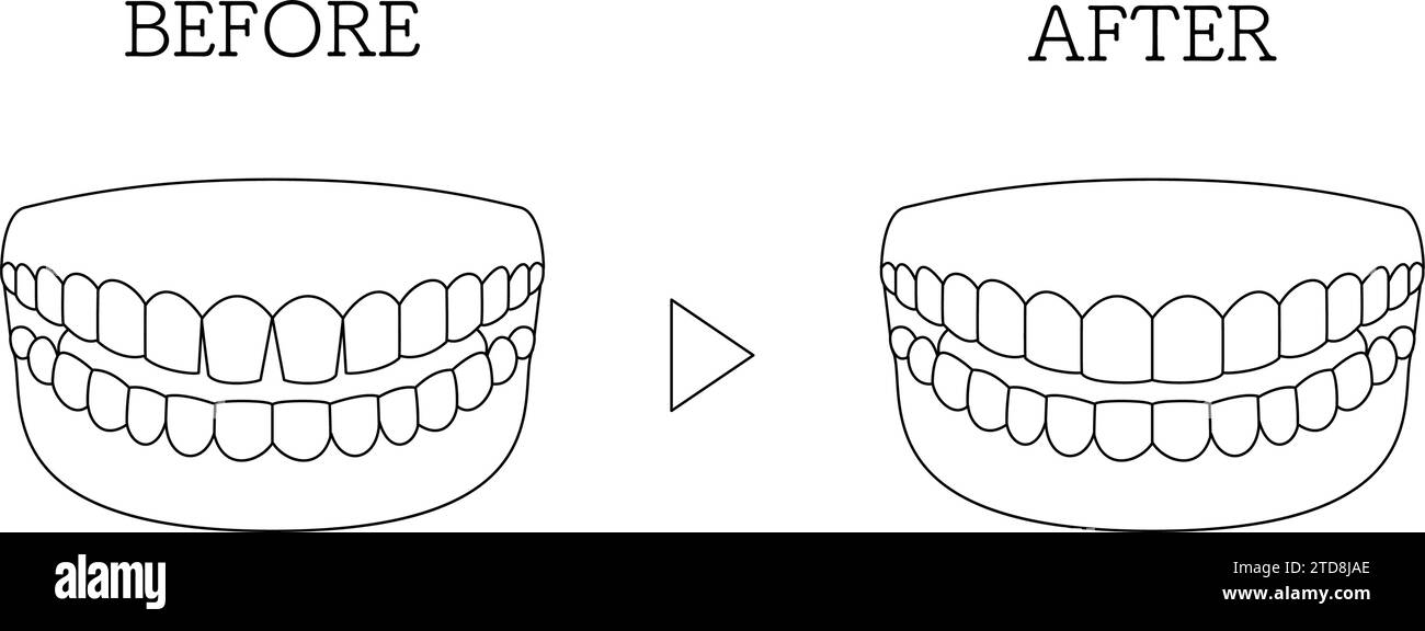 Cosmetic Dentistry, Direct Bonding Before and After, Gapped Anterior Teeth, Vector Illustration Stock Vector