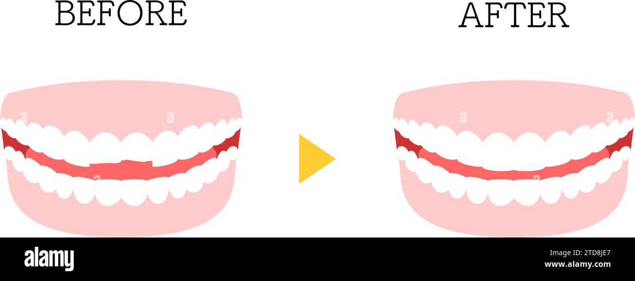 Cosmetic dentistry, direct bonding before and after, chipped tooth, Vector Illustration Stock