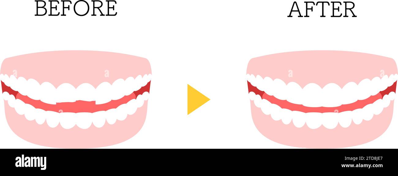 Cosmetic dentistry, direct bonding before and after, chipped tooth, Vector Illustration Stock Vector