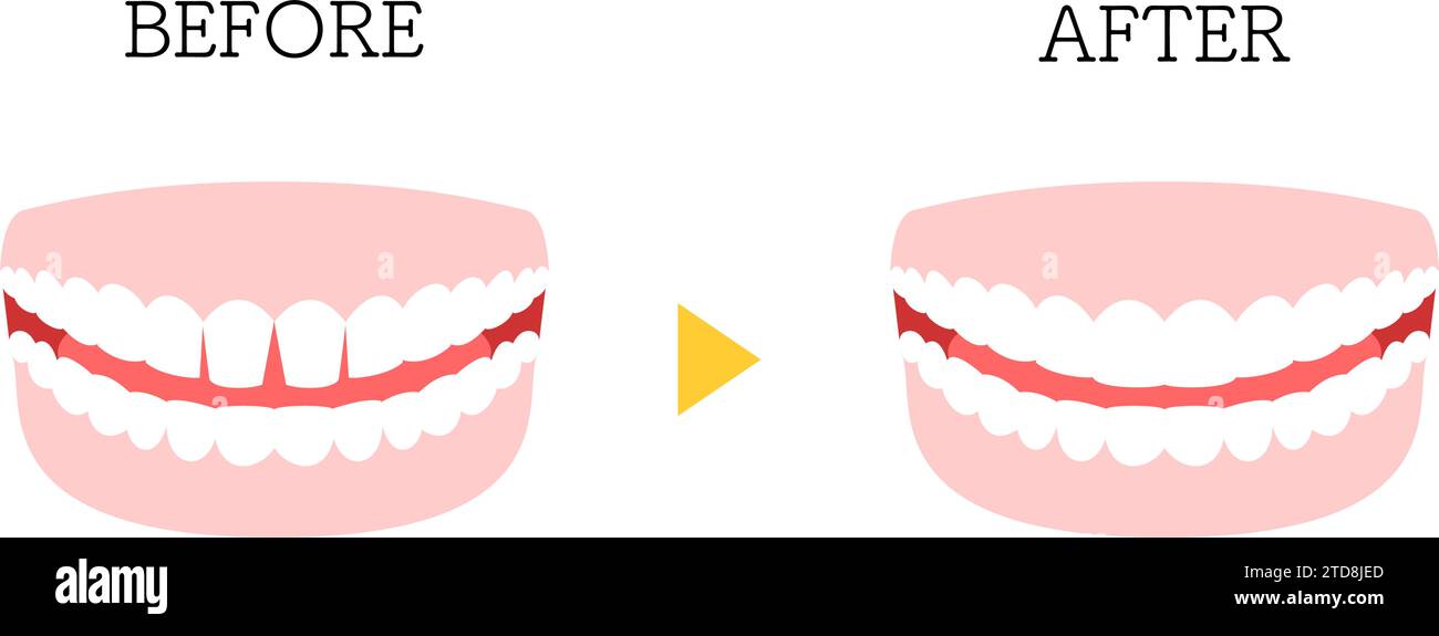 Cosmetic Dentistry, Direct Bonding Before and After, Gapped Anterior Teeth, Vector Illustration Stock Vector