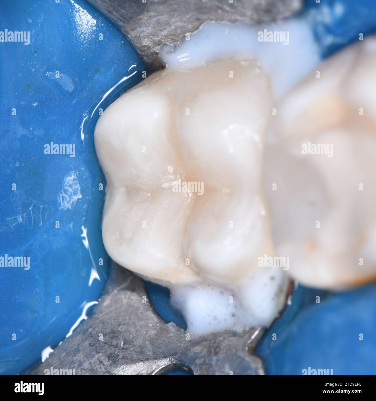 Cavity treatment hi-res stock photography and images - Alamy