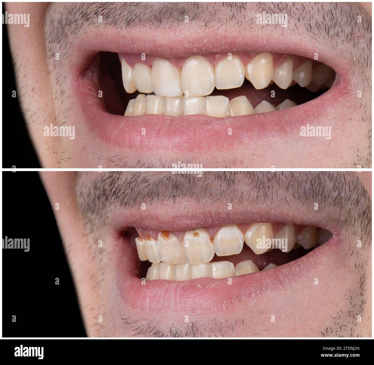 Emax crowns and veneers Stock Photo Alamy