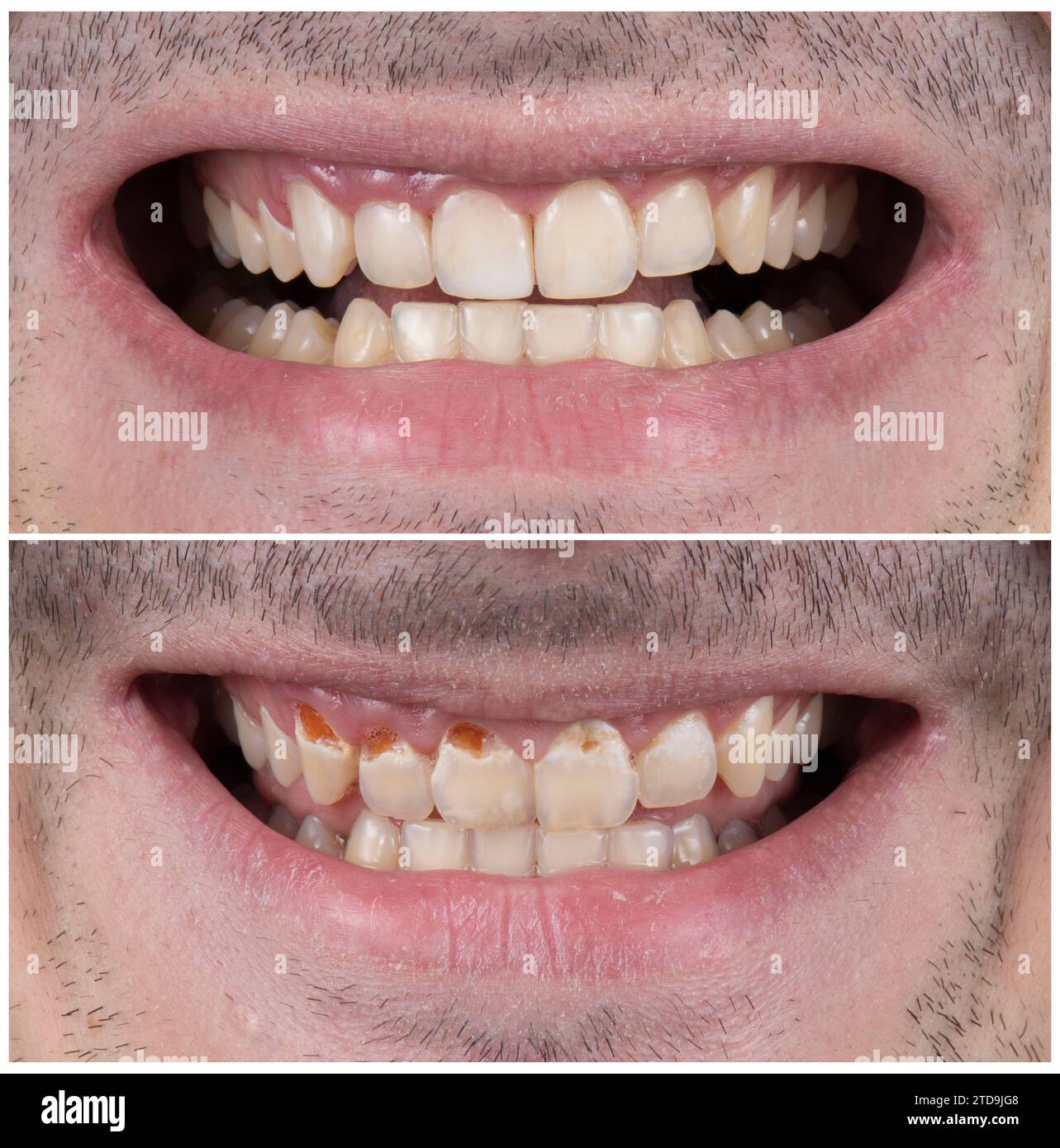 Emax crowns and veneers Stock Photo Alamy