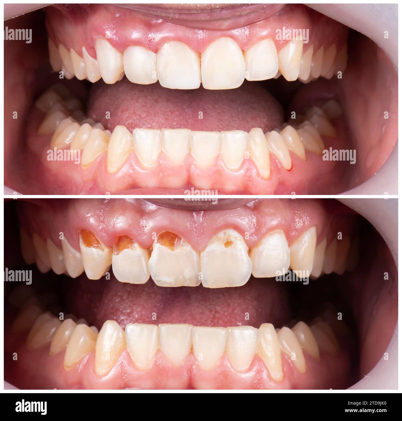 Emax crowns and veneers Stock Photo Alamy