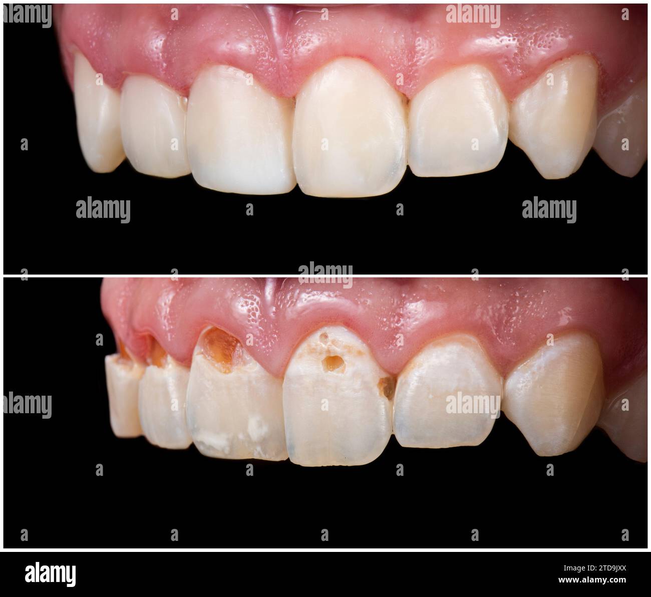 Emax crowns and veneers Stock Photo Alamy