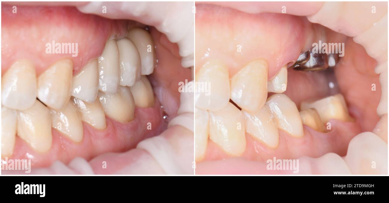 Emax crowns and veneers Stock Photo Alamy