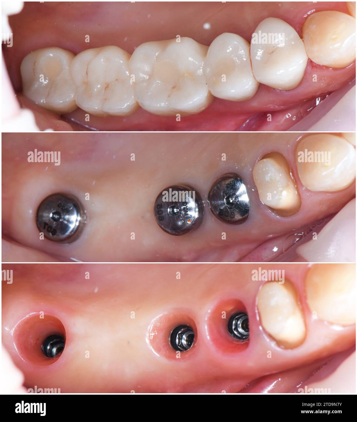 Emax crowns and veneers Stock Photo Alamy