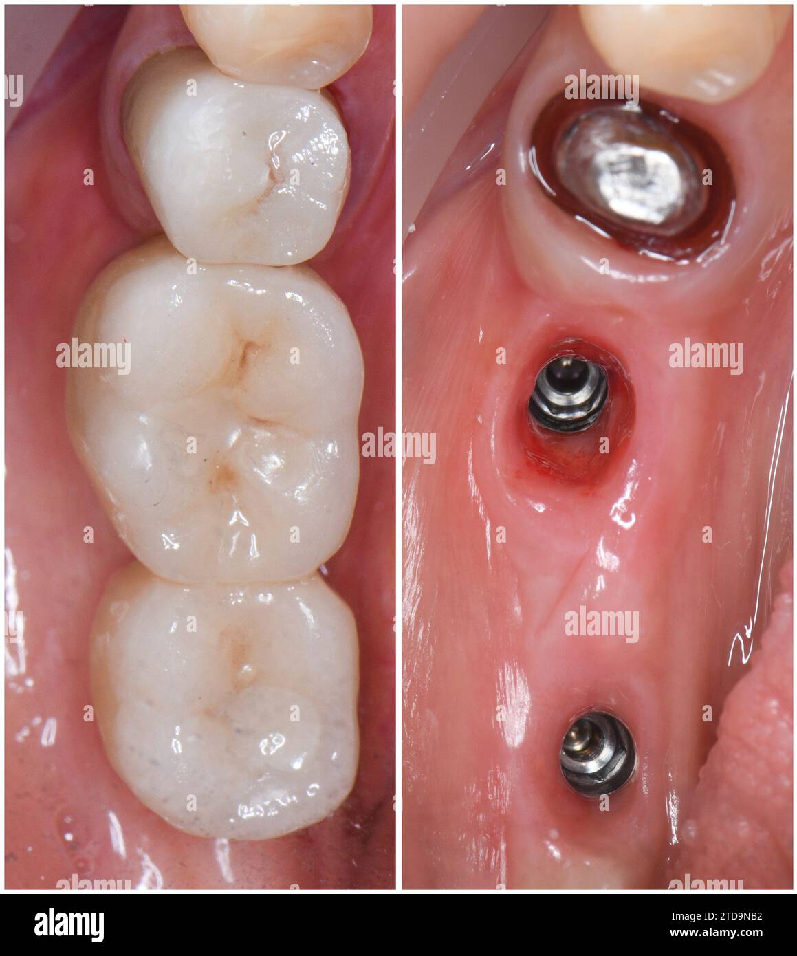 Emax crowns and veneers Stock Photo Alamy