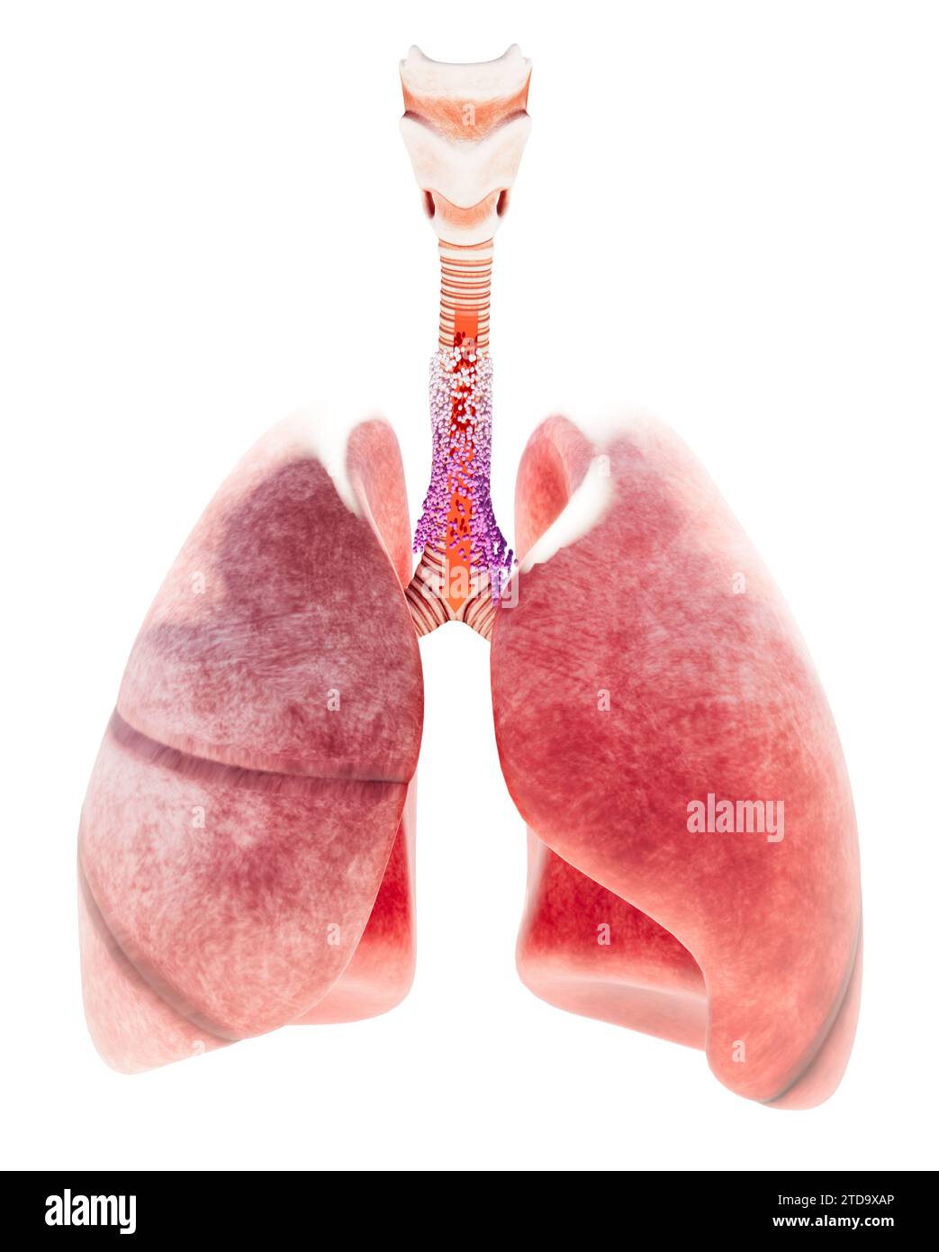 Trachea and bronchial tree, inflammation causing bronchitis. Acute or chronic inflammation. Viral bronchitis is caused by a virus and is a contagious Stock Photo