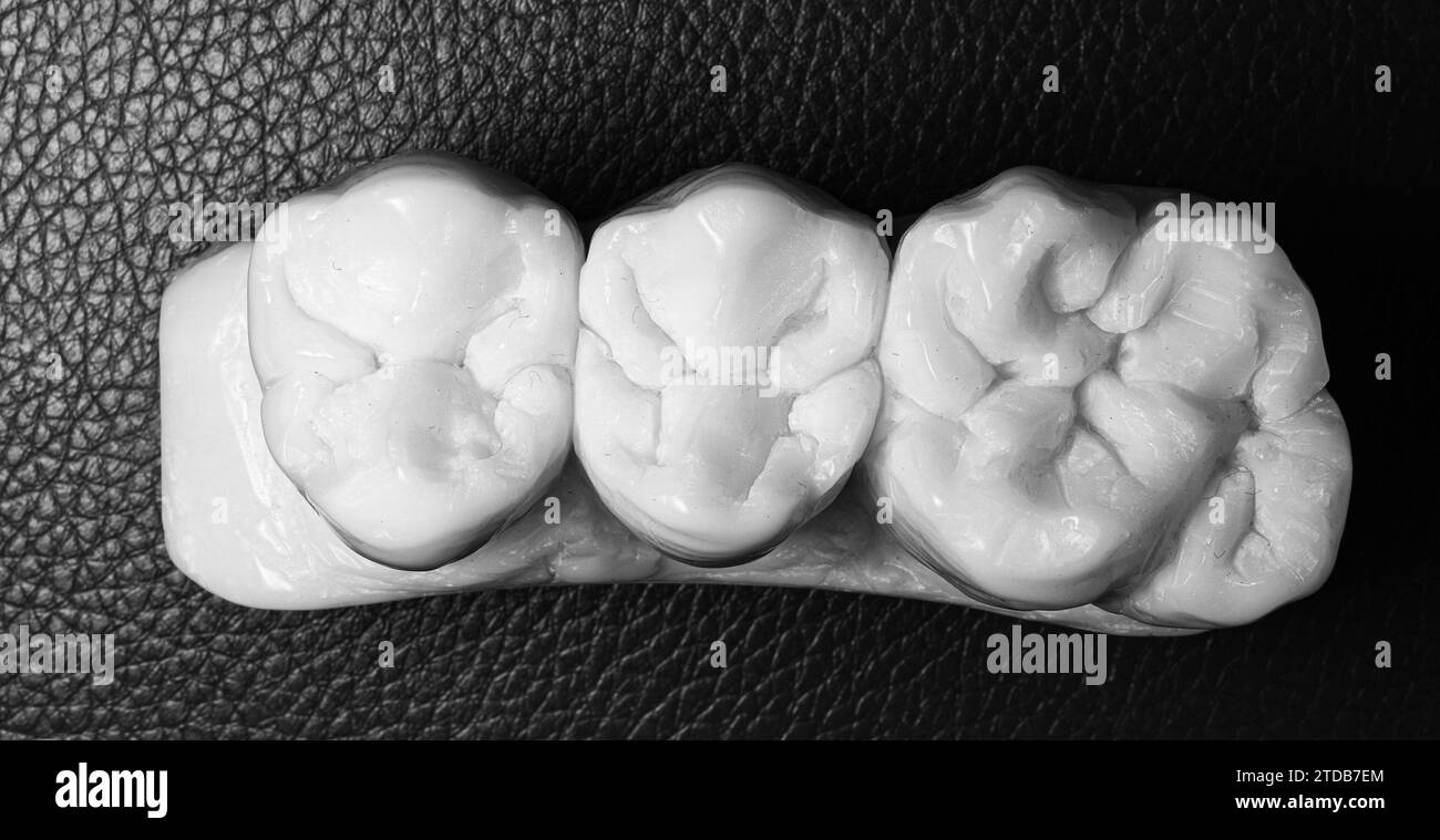 ceramic crowns and veneers Stock Photo Alamy