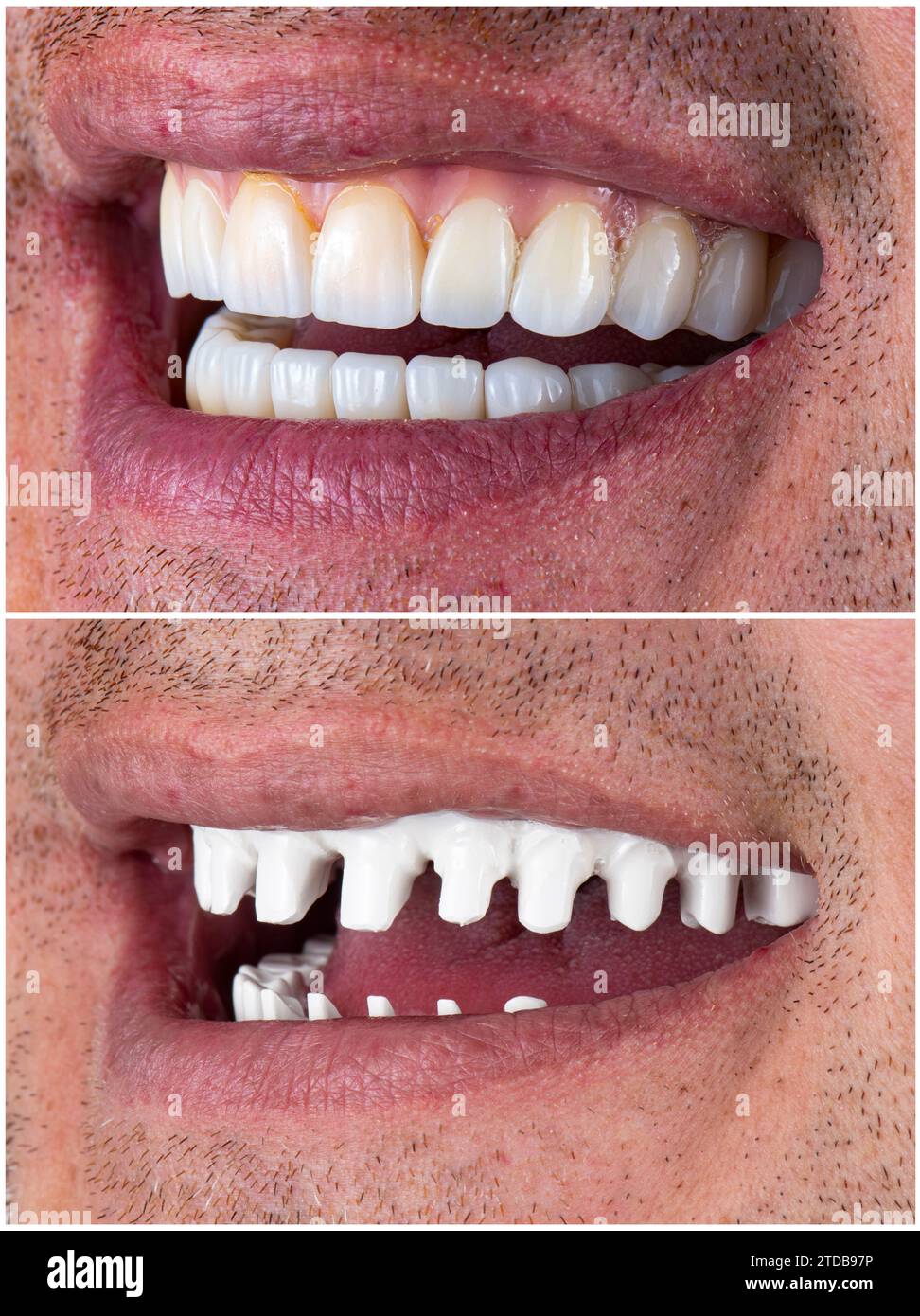 ceramic crowns and veneers Stock Photo Alamy