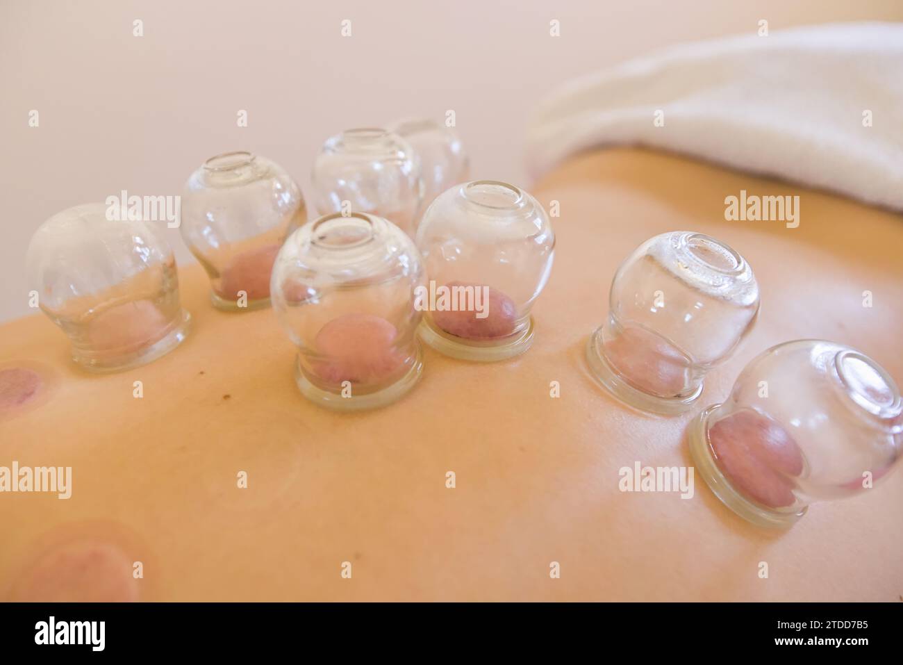 Traditional Chinese Cupping Therapy on the Back by Naturopath. Chinese