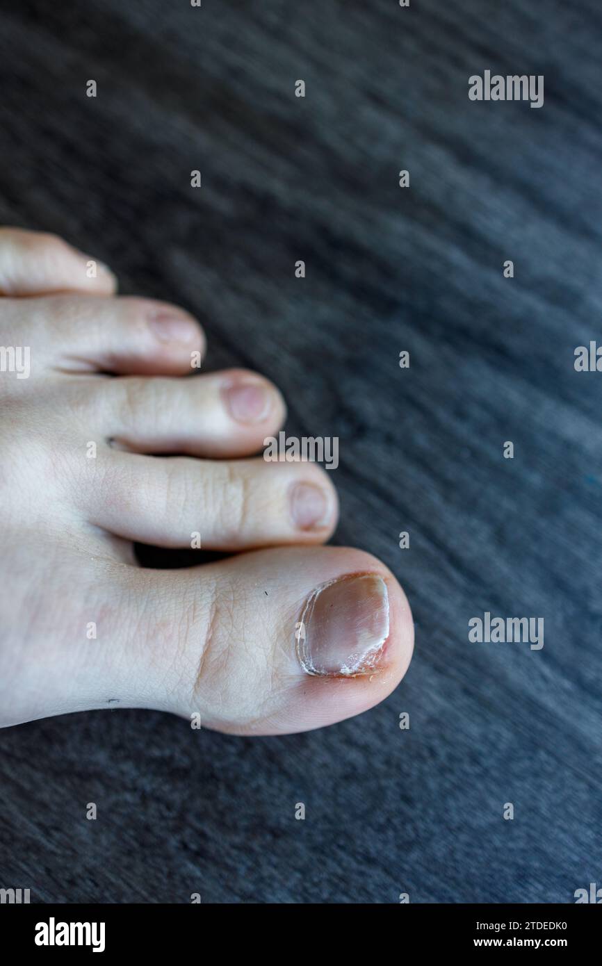 View of partial detachment of the toenail from the nail bed due to Onycholysis, fungal infection Stock Photo