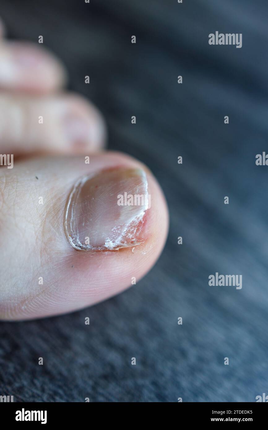 Close up view of partial detachment of the toenail from the nail bed due to Onycholysis, fungal infection Stock Photo