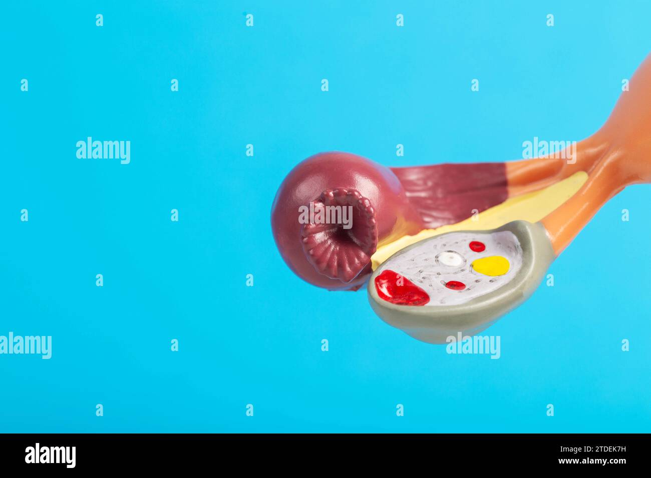 Female ovary close-up on a blue background of a medical mockup. The concept of ovary removal about cancer of the female reproductive system. Diseases Stock Photo