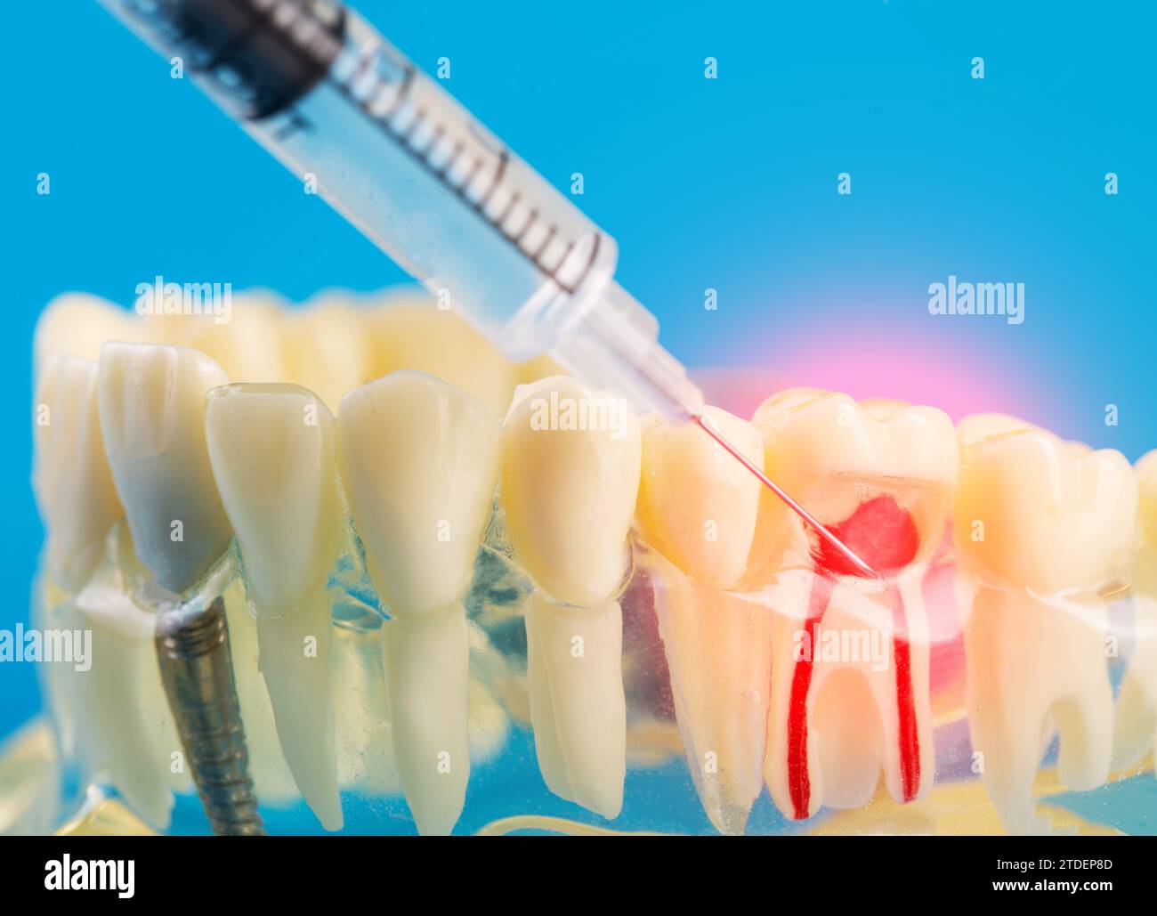 A syringe with an anesthetic anesthetic drug makes an injection into an inflamed tooth of a mock-up of a medical dental jaw on a blue background. Conc Stock Photo