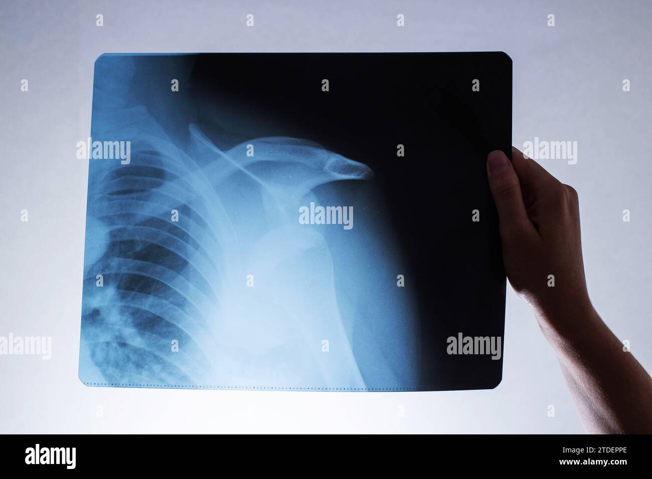 A woman's hand holds an x-ray of a patient with a dislocated shoulder and a fractured collarbone, osteoporosis. Surgery to reconstruct the shoulder jo Stock Photo