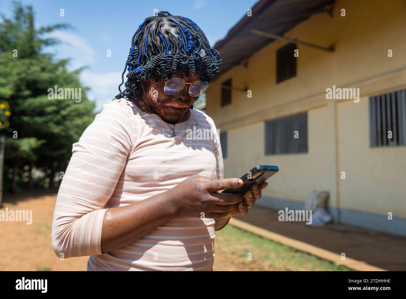Young African burned face girl on her smartphone writing messages. Stock Photo