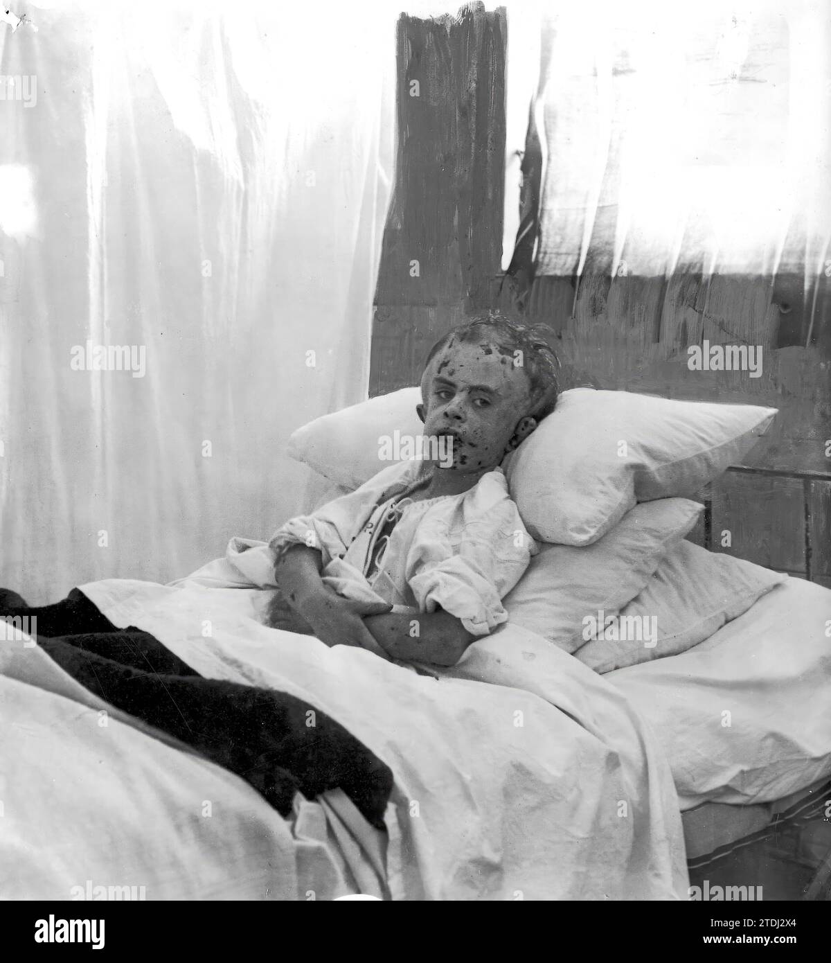07/16/1908. A Martyred creature. Madrid. The girl Anita Álvarez, victim of ill treatment by her stepmother. Credit: Album / Archivo ABC / Ramón Alba Stock Photo