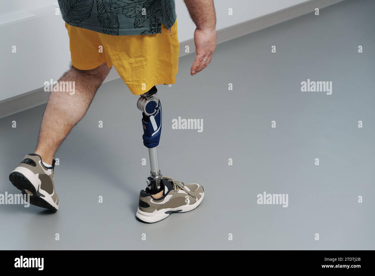 Active Lifestyle with Advanced Prosthetic Leg Technology Stock Photo