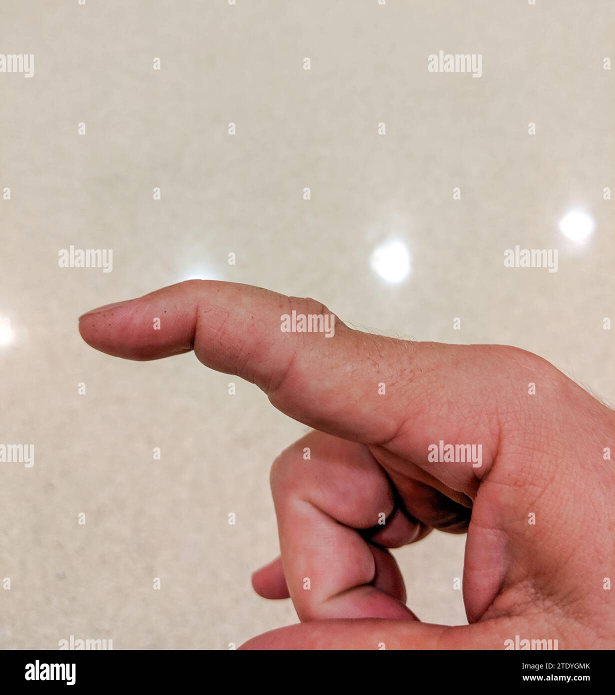 Picture of a dislocated index finger Stock Photo
