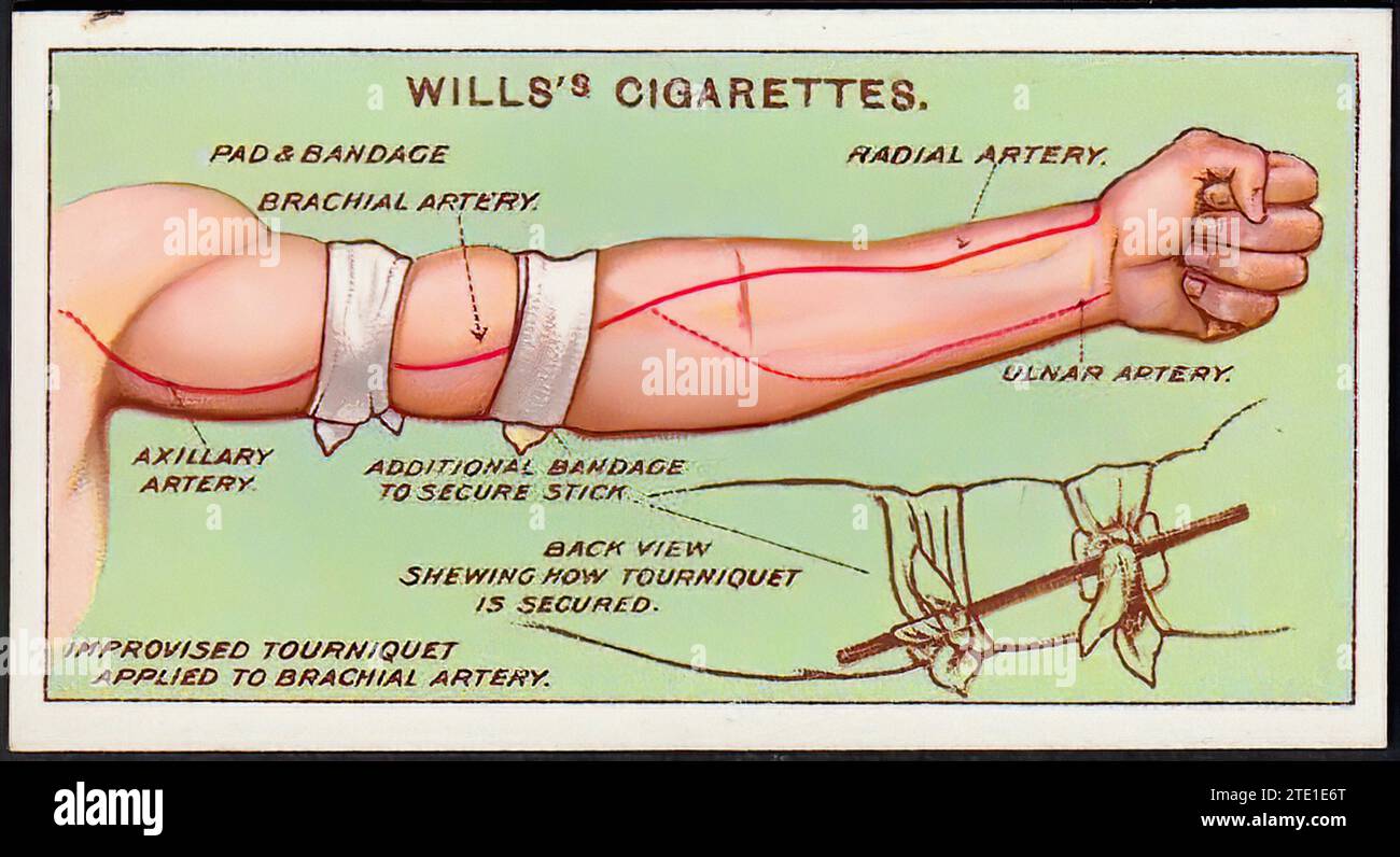 First Aid, Improvised Tourniquet Vintage Cigarette Card Illustration