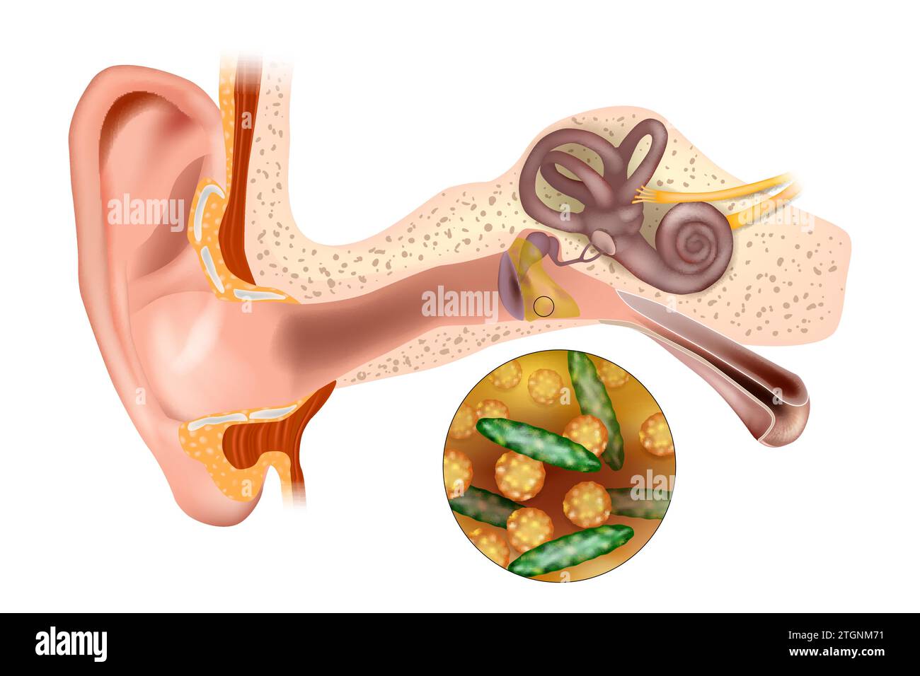Ear infection middle ear. Bacterial ear infection. Streptococcus pneumoniae and Haemophilus influenzae Stock Vector