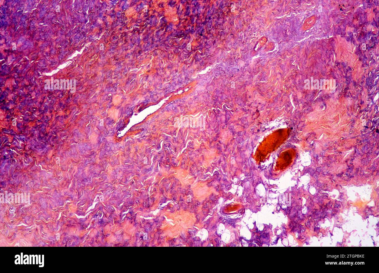 Fibrocartilage is a kind of cartilage tissue. Photomicrograph. Stock Photo